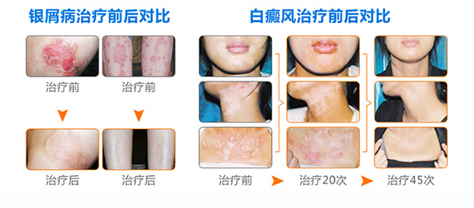 河南紫外线光疗仪-半身型（KN-4002B1）
