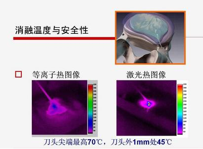 解释等离子手术系统&nbsp;&nbsp;低温等离子微创手&nbsp;&nbsp;低温等离子手术刀&nbsp;&nbsp;低温等离子消融术
